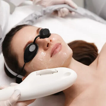 IPL - Photofacial